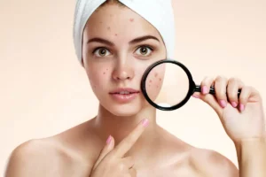 Acne treatment in West Palm Beach, Florida