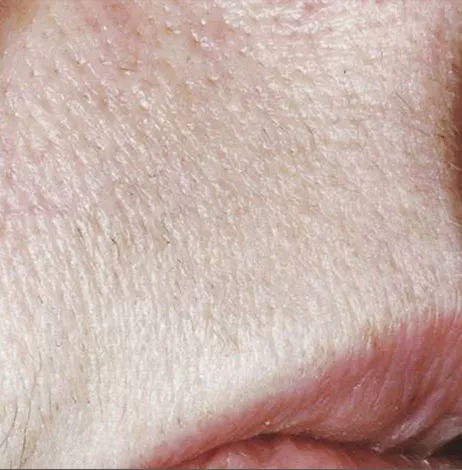 Laser hair reduction Jupiter for all skin types