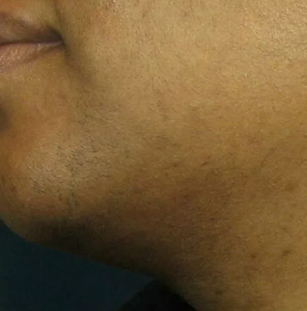 Facial hair laser removal in Palm Beach Gardens, FL