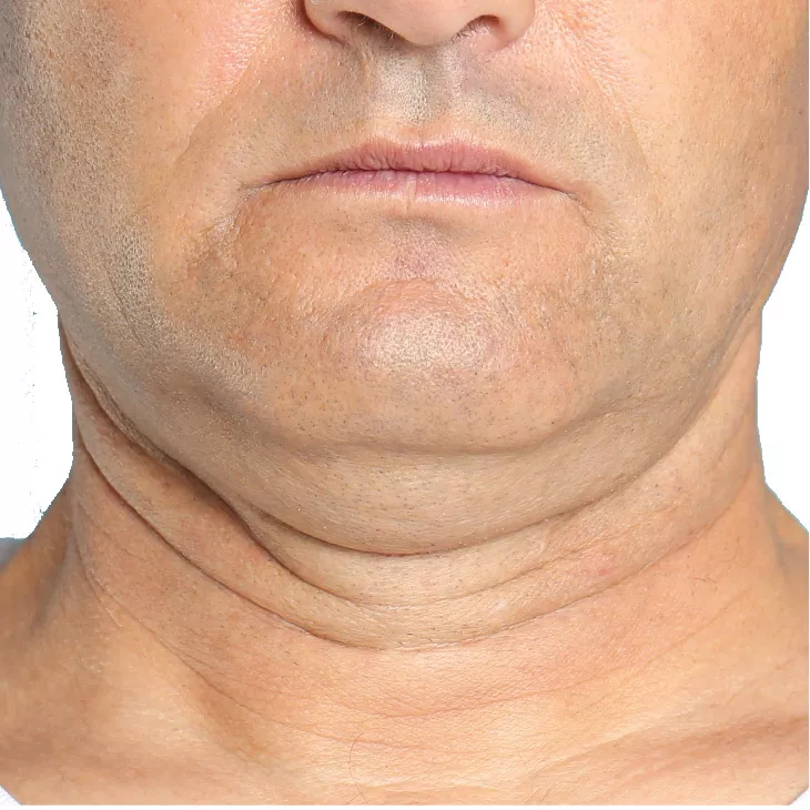 Professional Jupiter light therapy services