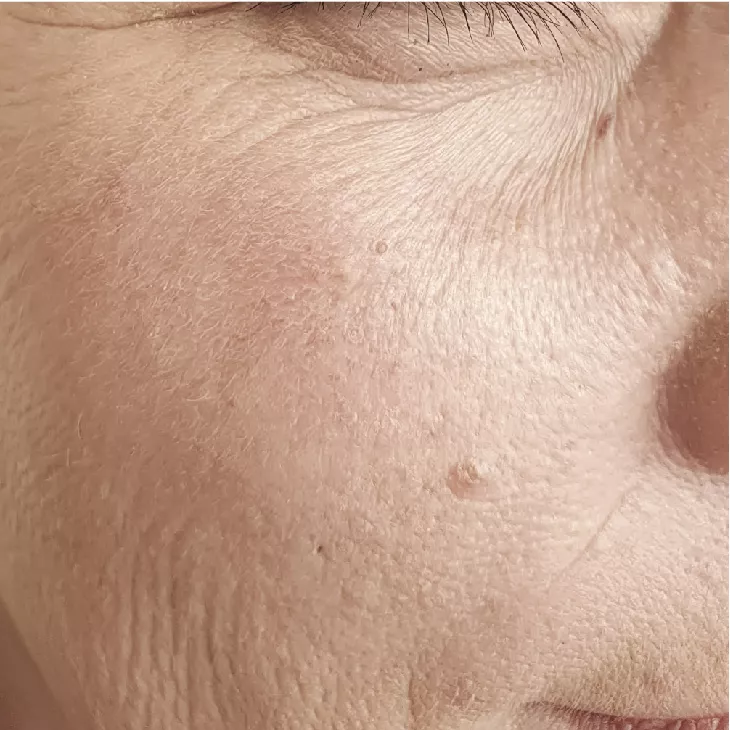 Before light therapy in Palm Beach Gardens, Florida