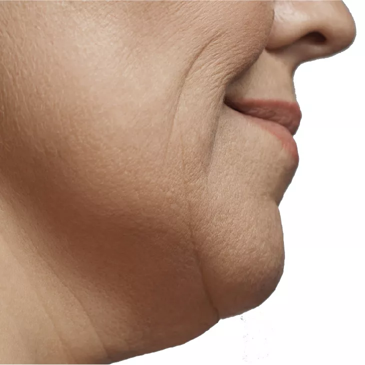Palm Beach Gardens before body contouring​