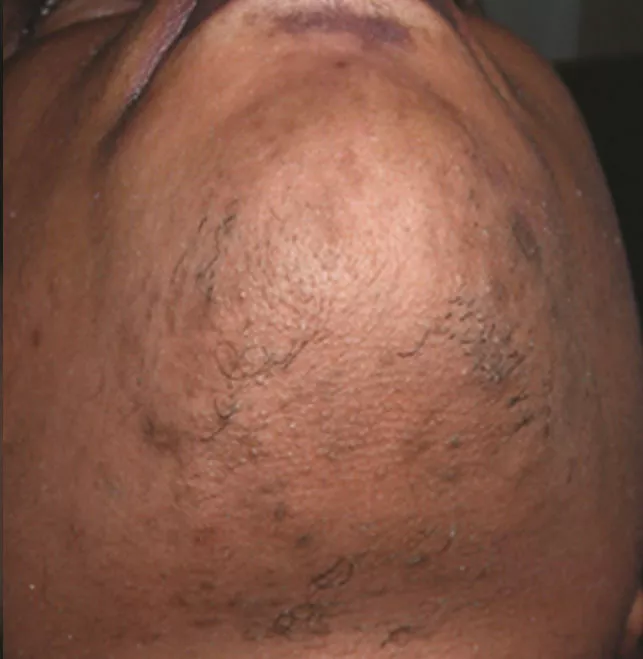 Laser hair removal in West Palm Beach
