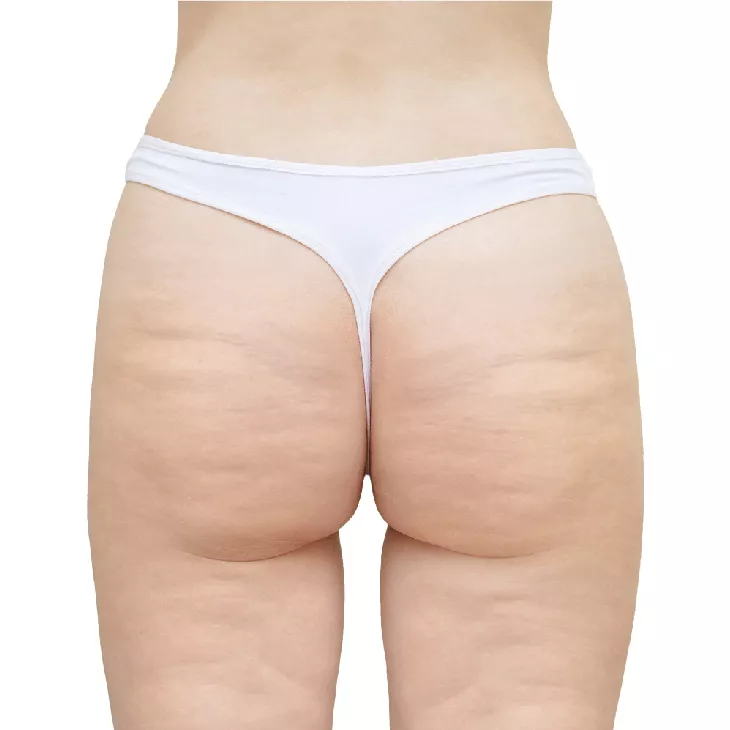 Before skin tightening in West Palm Beach, FL​