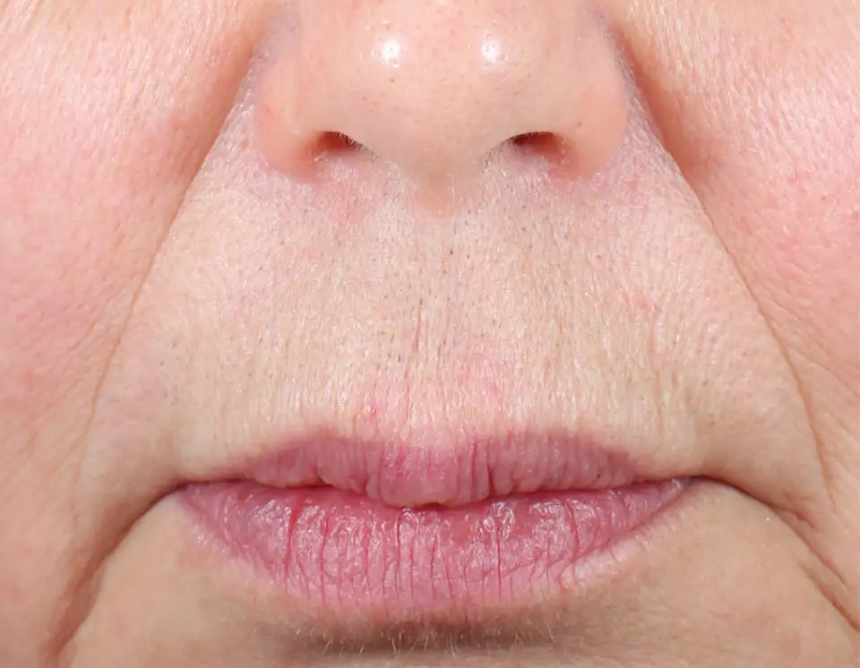 Effective laser hair removal Jupiter FL results