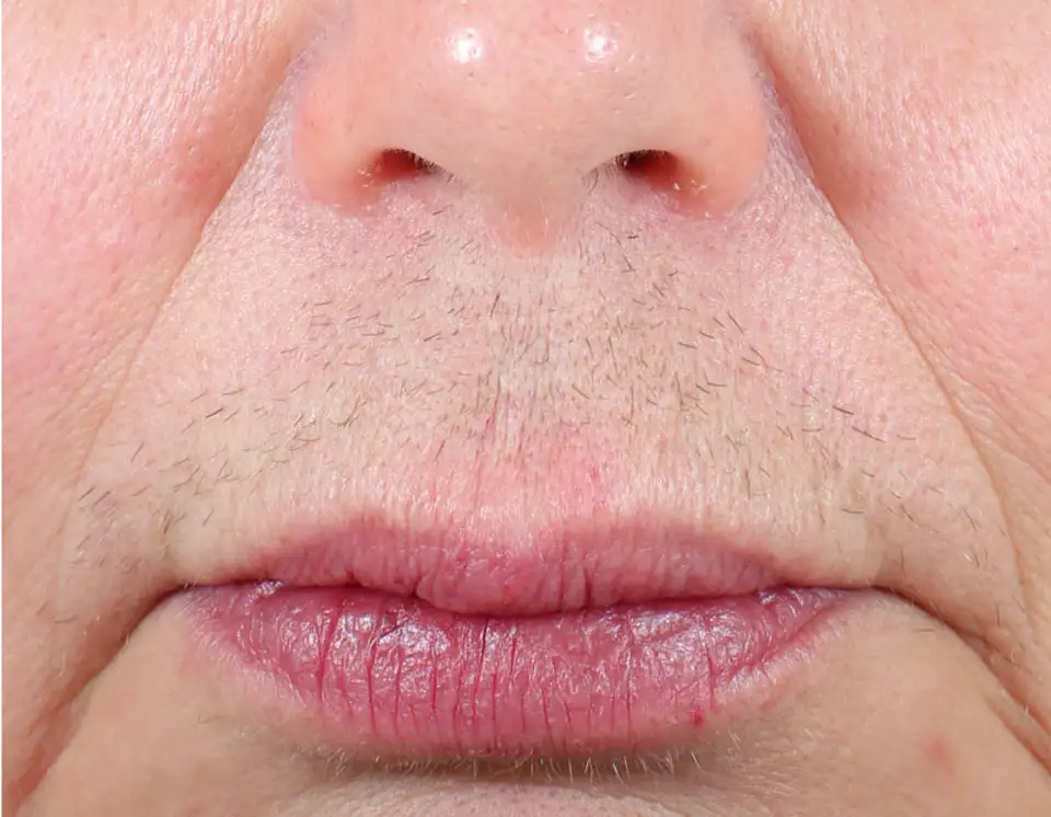 Trusted laser hair removal Jupiter FL specialists