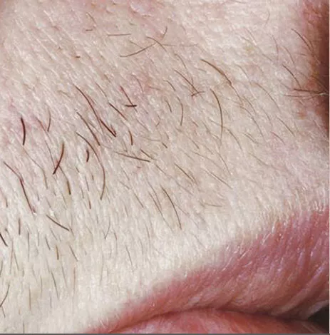 Laser hair reduction Jupiter residents trust