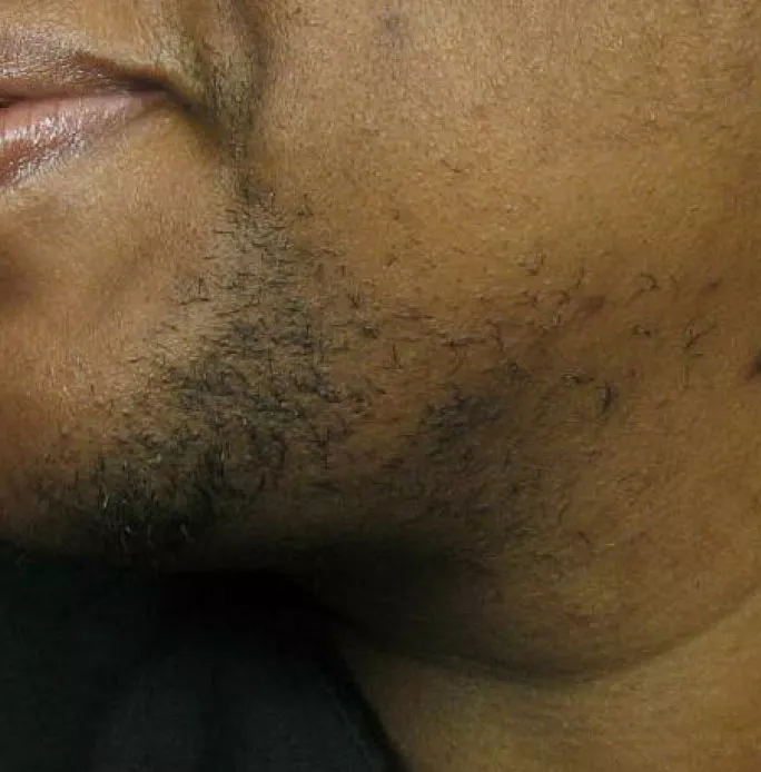 Facial hair laser removal in Palm Beach Gardens