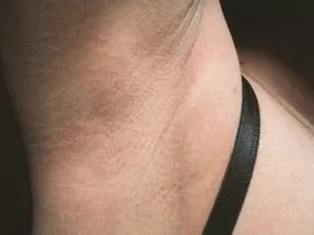 Licensed laser hair removal Palm Beach technicians