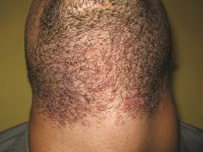 Laser hair removal in Palm Beach, FL