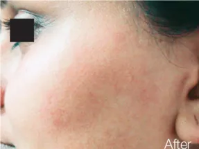 Pain-free facial laser hair removal Palm Beach Gardens technology