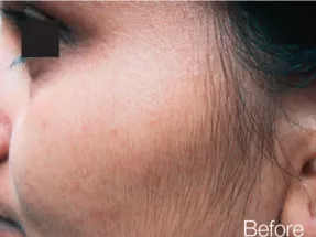 Top-rated laser hair removal Palm Beach Gardens clinics