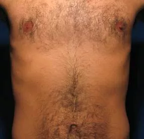 Effective laser hair removal treatments in West Palm Beach, FL
