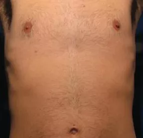 Non-invasive laser hair removal in Jupiter and West Palm Beach