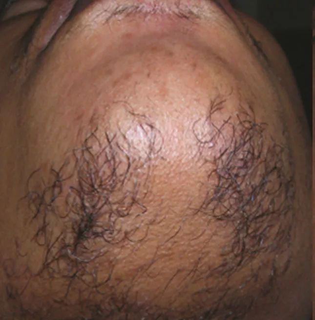 Chin laser hair removal West Palm Beach FL