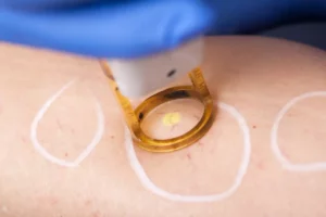 Spider vein removal in Palm Beach Gardens, Florida