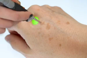 Excellent laser treatments in Palm Beach Gardens, FL