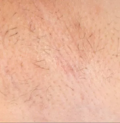 Laser hair removal West Palm Beach FL for sensitive skin
