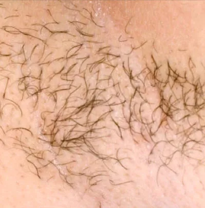Underarm laser hair removal West Palm Beach FL