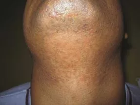 West Palm Beach laser hair removal results that last