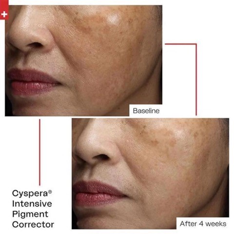 Cyspera Before and After