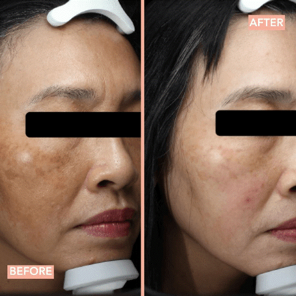 Cyspera Before and After